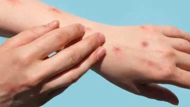 Ecuador registra 7 casos de viruela del mono, según el MSP