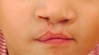 Operación Sonrisa devuelve la sonrisa a pacientes en Riobamba