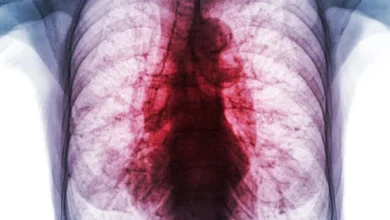 Riobamba registra 35 casos anuales de tuberculosis