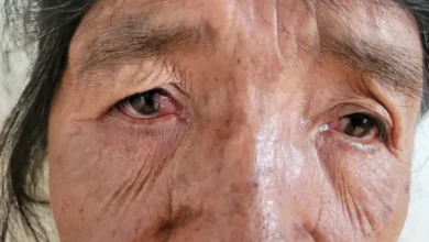 Mujer de 64 años de Chambo necesita operación en los ojos