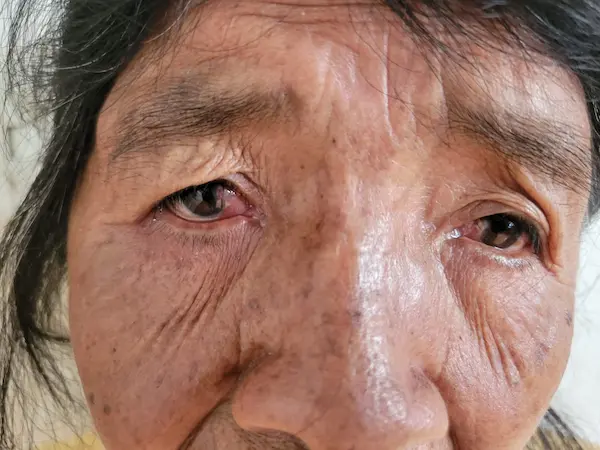 Mujer de 64 años de Chambo necesita operación en los ojos