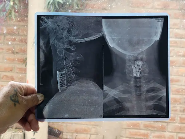 Cilindro colocado en la cervical, cuya operación y estancia costó USD 65.000