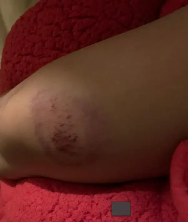 Herida registrada a la altura del muslo