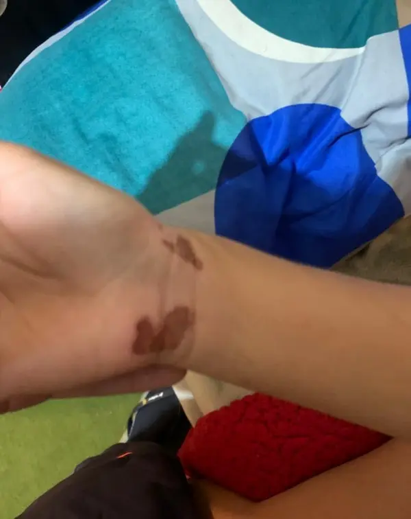 La parte de la mano y la muñeca sintieron fuertemente el golpe