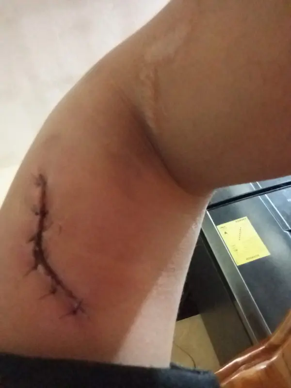 La otra cornada que recibió