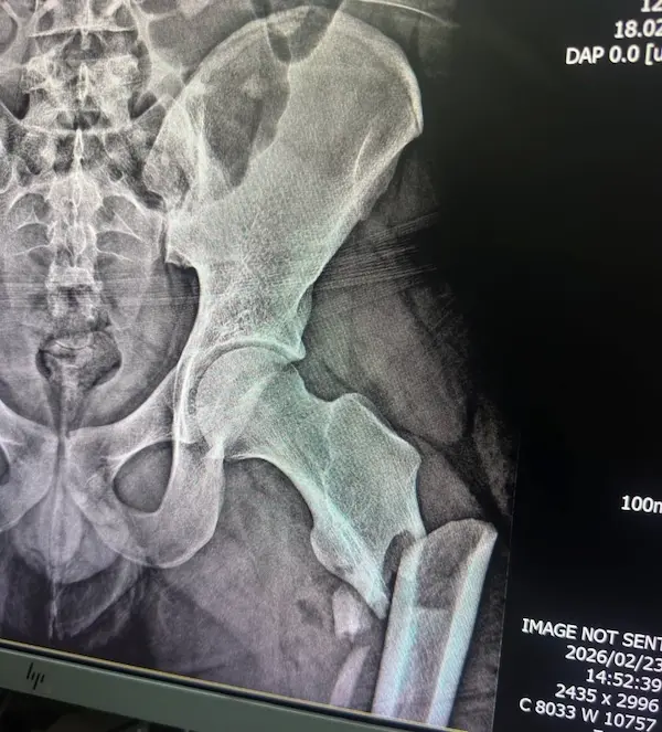 Los exámenes confirmaron la valoración inicial de los paramédicos. 