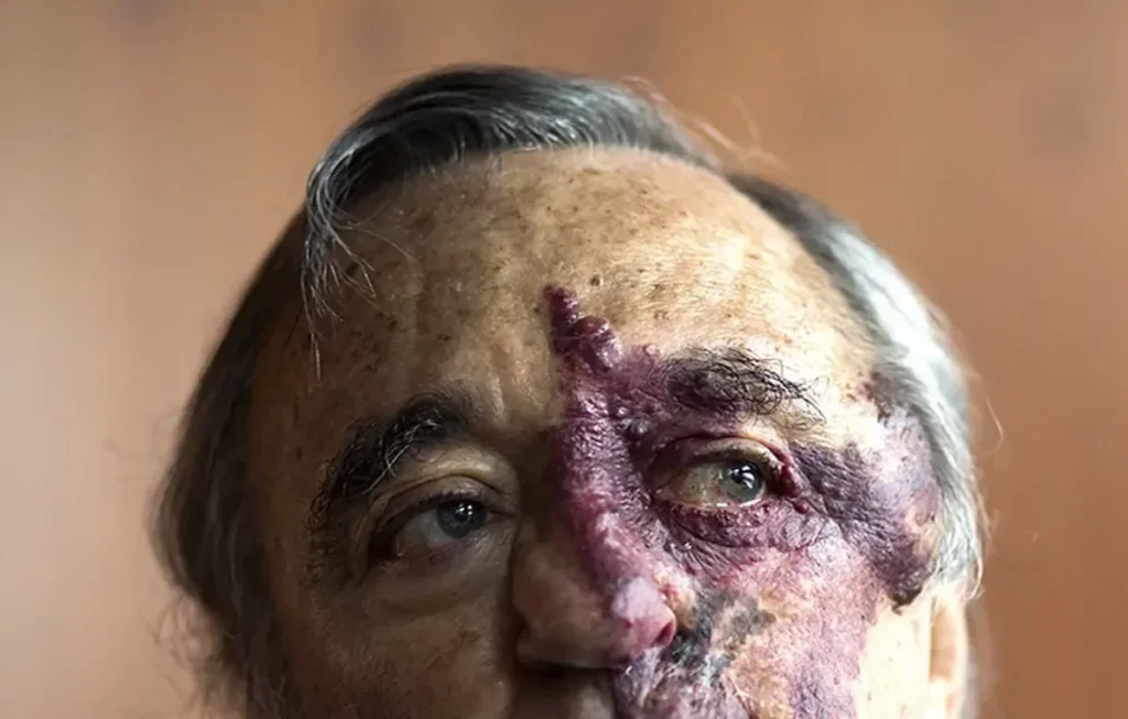 Mariano Barbacid: descrubre la cura del cáncer de páncreas