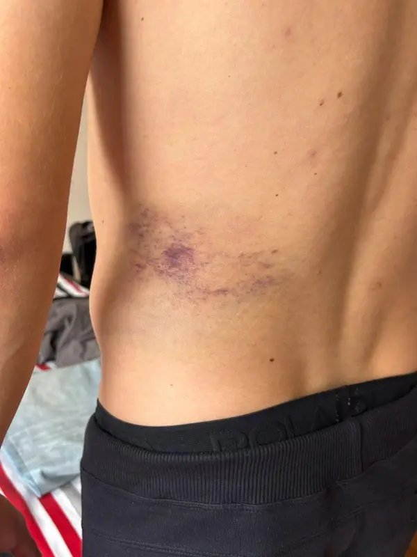 Golpes en la espalda