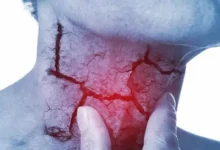 VPH supera al tabaco como principal causa de cáncer de garganta